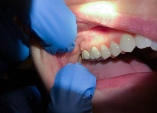 Best Tooth Infection Emergency Dentist  in Shippensburg, PA